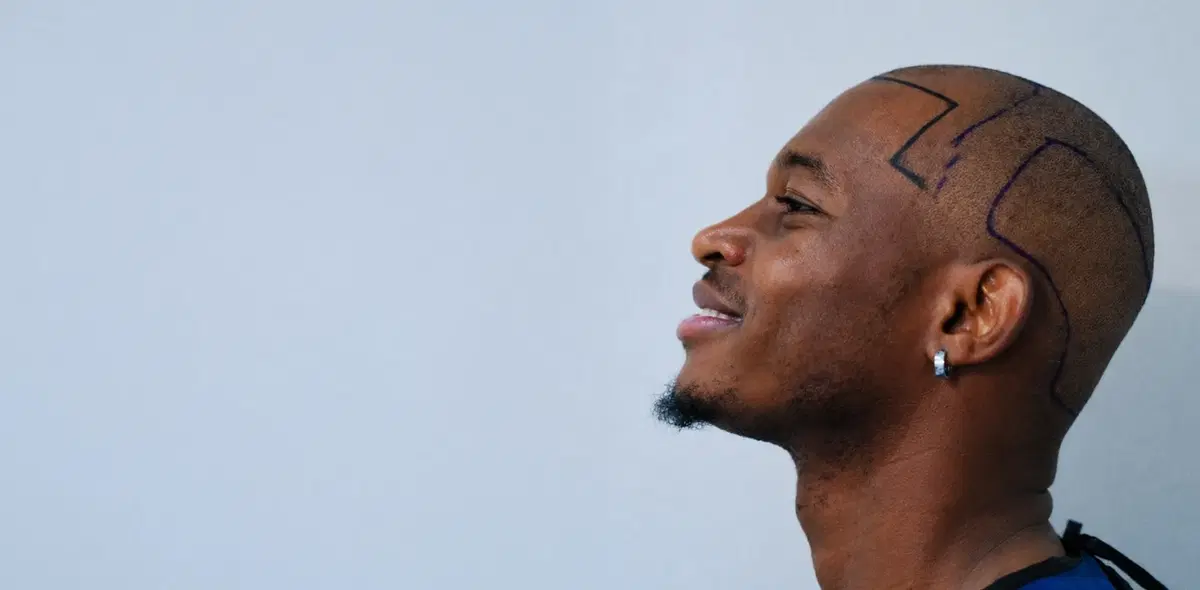 Complete Hairline Restoration