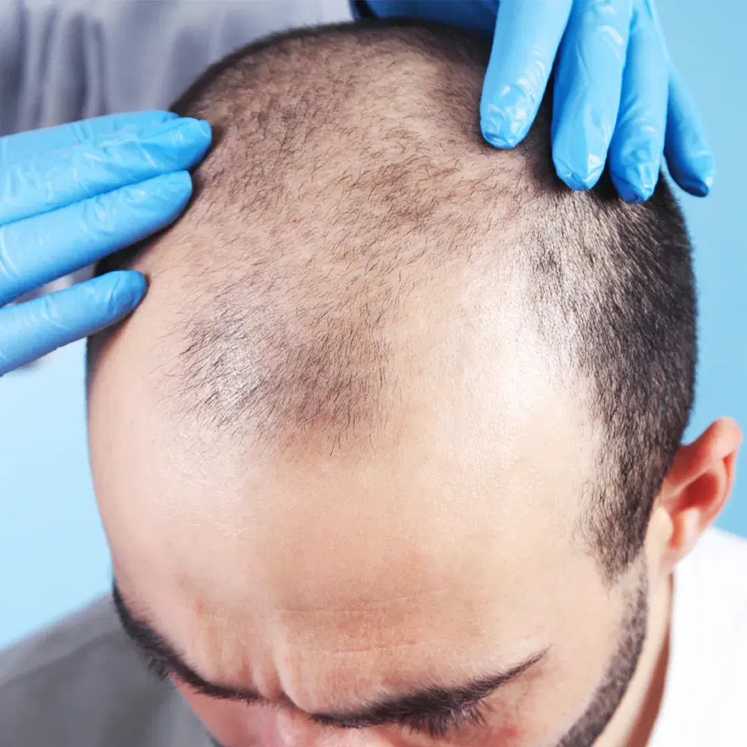 FUE Hair Transplant