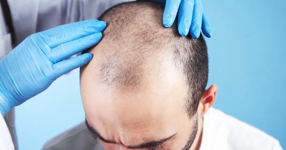 Trasplante Capilar FUE