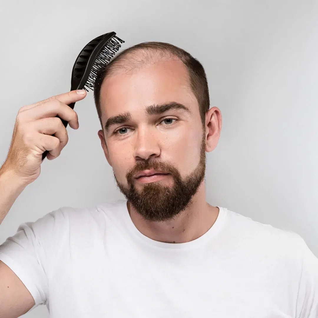 Men’s Hair Loss: Causes, Prevention, and Solutions