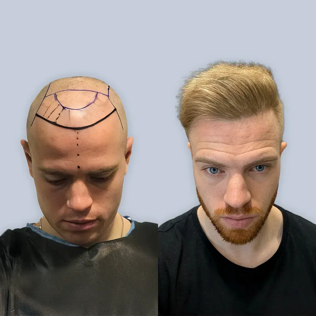 Hair Transplant Before and After Results
