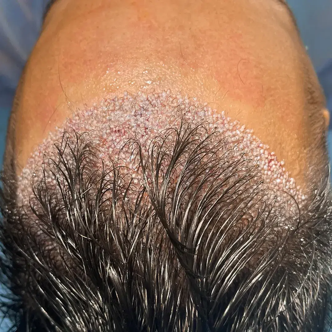 Unshaven Hair Transplant