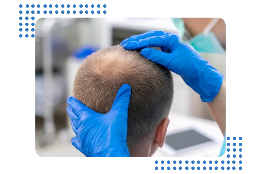 FUE Hair Transplant