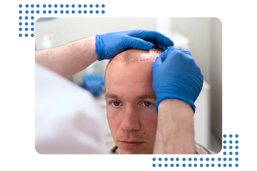 DHI Hair Transplant