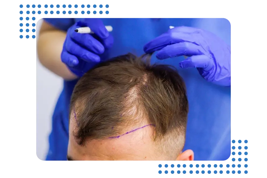 Unshaven Hair Transplant