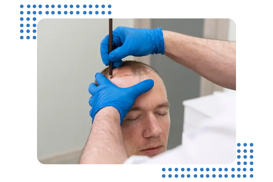 Miami Hair Transplant Prices